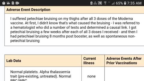 VAERS: 40 YR OLD WOMAN LITERALLY GETS BRUISED AFTER JUST THREE SHOTS!