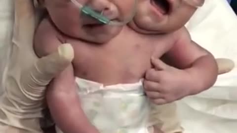 A Mexican woman gives birth to a baby with two heads
