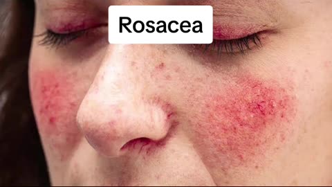 2023's Ultimate Skin SOS: Eczema, Rosacea, Acne Tips! #shorts