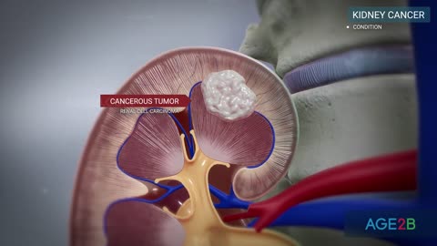 The Kidney and Kidney Cancers | What Are Some Symptoms of Kidney Cancer?