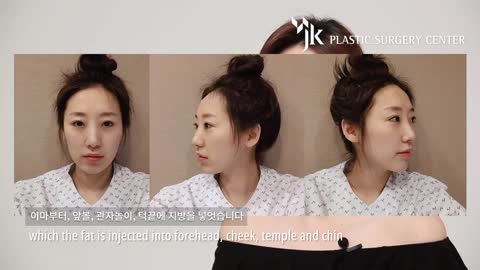 Fat Grafting at JK Plastic Surgery! Korean Plastic Surgery