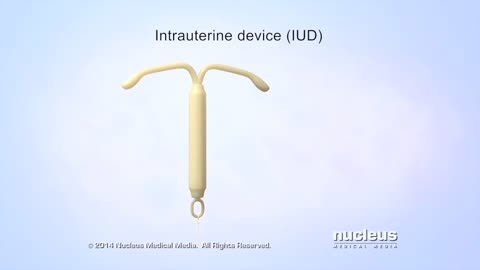 What is an IUD