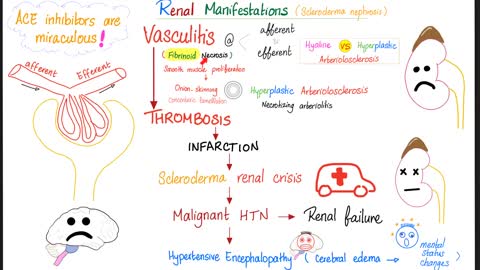 Systemic Sclerosis (Scleroderma)