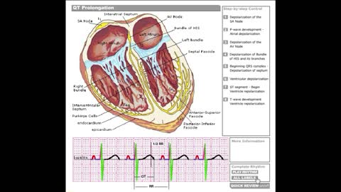 Dr Stanley's ECGcourse.com | QT Interval Prolongation Tutorial