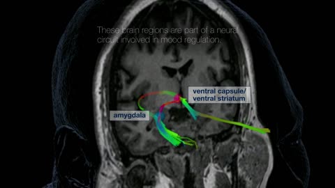 Personalized Deep Brain Stimulation Therapy (DBS)