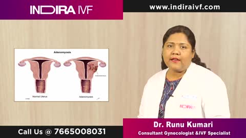 Adenomyosis: Know What is Adenomyosis Uterus at Indira IVF