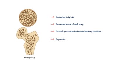 Signs Of Low Testosterone (Male Hypogonadism) _Low Testosterone Signs