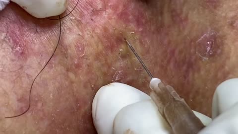 Big Cystic Acne Blackheads Extraction Blackheads & Milia, Whiteheads Removal Pimple Popping