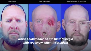 Surgeons perform world's first eye transplant