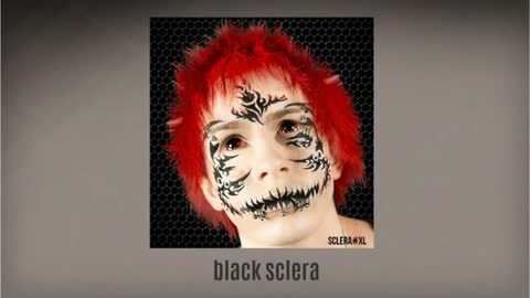 black sclera