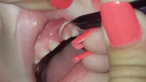 Nail Biting Video