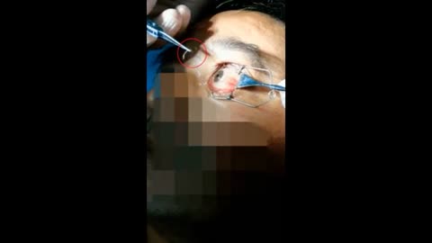 Doctor Plucks Wriggling Worms From Dog Owners Eye