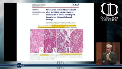 myocarditis in young adults