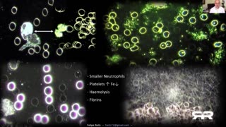 Thermographic imaging shows the extent of clotting after a healthy 23 year old has the jab.