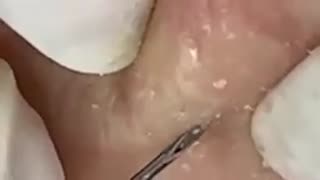 dr pimple popper,drpimplepopper,pimple popping,