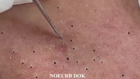 Popping Tons Of Blackheads