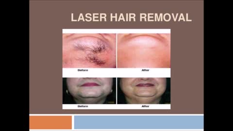 Painfree Laser Hair Removal In Delhi