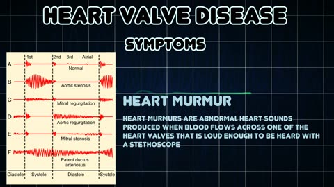 Symptoms, risk factor and treatment of Heart valve diseases