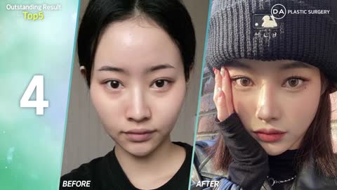 TOP 5 Plastic Surgery Before and After at DA!