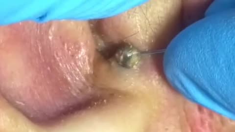 Best pimplepopper removal in the whorld