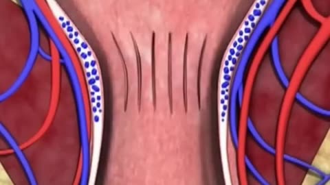 3D Animation video of Hemorrhoidoplasty