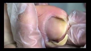 PAINFUL Toenail Ingrown Removal!!!!