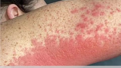 41-year-old hairdresser breaks out in horrible, painful rash immediately after AstraZeneca poison