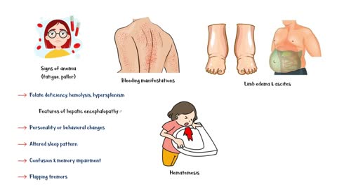 Signs And Symptoms Of Liver Cirrhosis