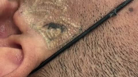 Laser Tattoo