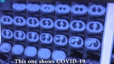 "Covid" vs Radiation pneumonitis