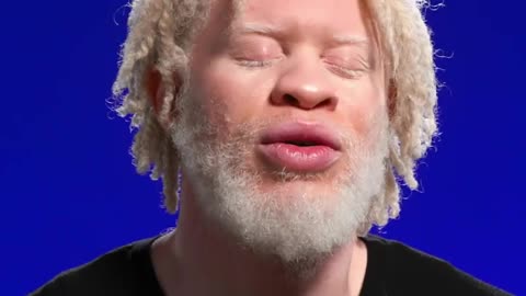 Albino model had to learn to overcome prejudices to find self-acceptance 🧡