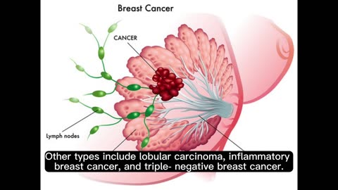 breast cancer, its causes, symptoms, and treatment #breastcancer #care #health #awareness #foryou