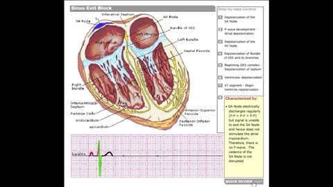 Dr Stanley's ECGcourse.com | Sinus Exit Block Tutorial