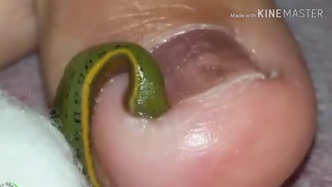 leech bite human experiment