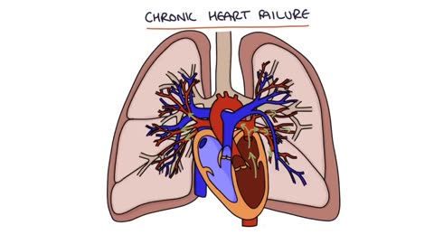 Understanding heart failure for students