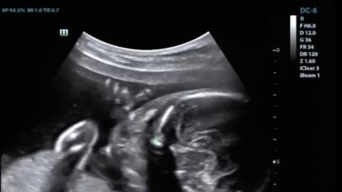 Unborn Baby Appears to Make Rock On Gesture in Ultrasound Video