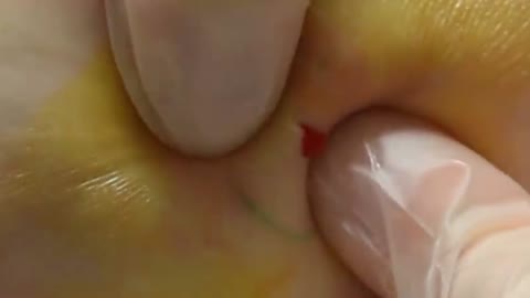 Giants Deep Blackheads, Whiteheads, Big Pimples, Hidden Acne Removal - Best Popping Videos #000026