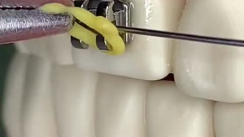 To Whiten Your Teeth in Less Than 16 Minutes Click on the Video Description
