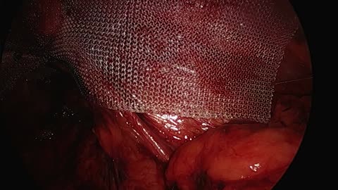 Sithsurgeon - Laparoscopic Extraperitoneal Right Inguinal Hernia Repair
