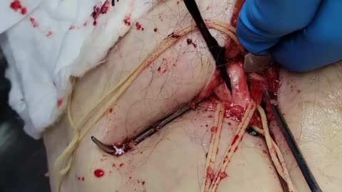 "This Is Not Normal" - Embalmer Richard Hirschman Releases Footage of Unbelievable Blood Clots
