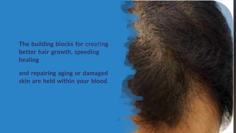 Advantages of PRP for Hair Growth - Canada MedLaser Clinics