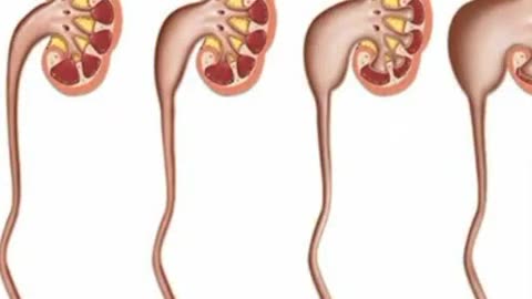 CKD_ON_SCAN__HYDRONEPHROTIC_KIDNEY___HYPERTENSIVE_KIDNEYS___1(480p)