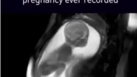 A Preborn Child IS a Human Life
