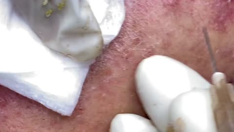 Big Cystic Acne Blackheads Extraction Blackheads & Milia, Whiteheads Removal Pimple Popping