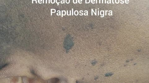 Removal of PAPULOSA Nigra Dermatosis.