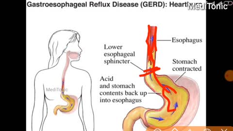 How to perform Endoscopy live process