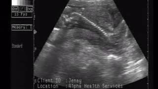 Ultrasound: Baby in the Womb - FETUS means LITTLE ONE!