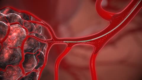 Agile Devices Angler™ steerable catheter - 3d animation