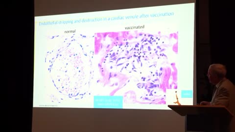 Eindeutige pathologische Befunde, die die Gefährlichkeit der Corona-"Impfung" belegen.