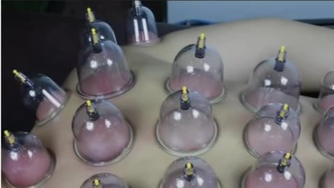 Chinese Acupoint Cupping Therapy, Pain Relief